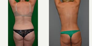 Liposuction procedure image