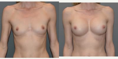 Breast Augmentation procedure image