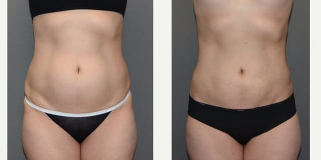 Mommy Makeover procedure image