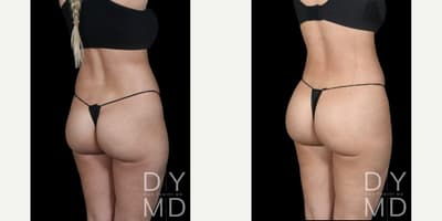 Brazilian Butt Lift (BBL) procedure image