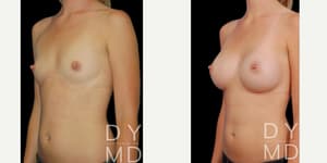Breast Augmentation procedure image
