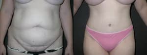 Tummy Tuck (Abdominoplasty) procedure image