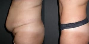 Mommy Makeover procedure image