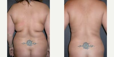 Liposuction procedure image