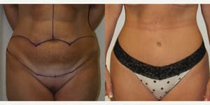 Tummy Tuck (Abdominoplasty) procedure image