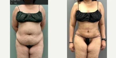 Mommy Makeover procedure image