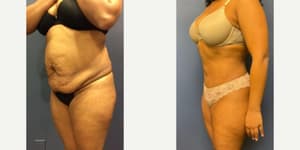 Skin Tightening procedure image