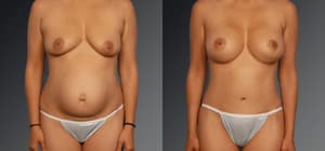 Mommy Makeover procedure image