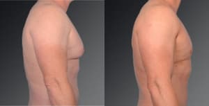 Body Lift procedure image