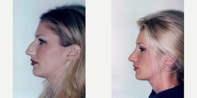 Rhinoplasty (Nose Job) procedure image