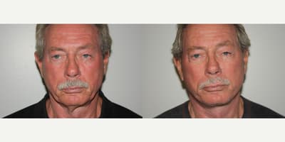 Neck Lift procedure image