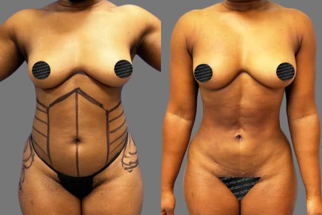 Breast Augmentation procedure image