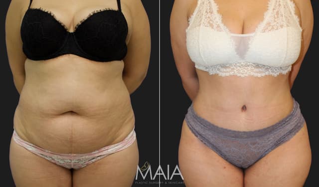 Tummy Tuck (Abdominoplasty) procedure image