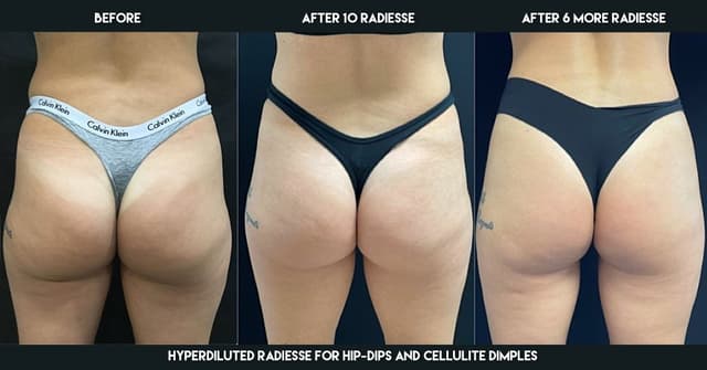 Brazilian Butt Lift (BBL) procedure image