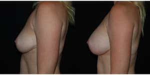 Mommy Makeover procedure image