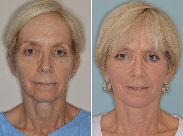 Facelift procedure image