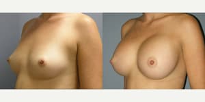 Breast Augmentation procedure image