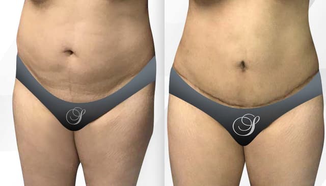 Tummy Tuck (Abdominoplasty) procedure image