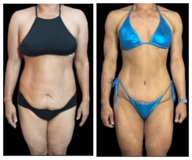 Mommy Makeover procedure image