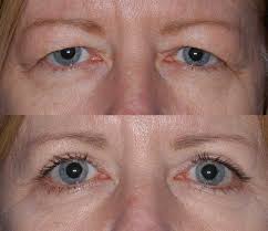 Eyelid Surgery (Blepharoplasty) procedure image