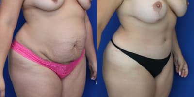 Mommy Makeover procedure image