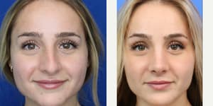 Rhinoplasty (Nose Job) procedure image
