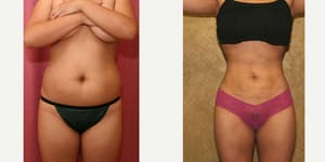 Tummy Tuck (Abdominoplasty) procedure image