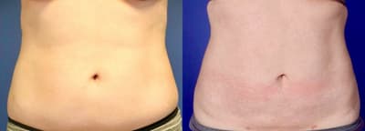 Liposuction procedure image