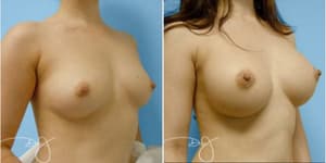 Breast Augmentation procedure image