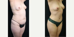 Tummy Tuck (Abdominoplasty) procedure image