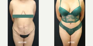 Mommy Makeover procedure image