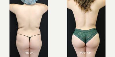 Brazilian Butt Lift (BBL) procedure image