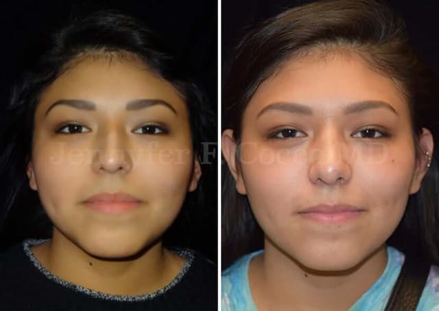 Rhinoplasty (Nose Job) procedure image