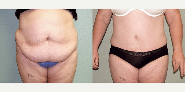Tummy Tuck (Abdominoplasty) procedure image