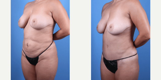 Breast Augmentation procedure image