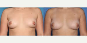 Mommy Makeover procedure image