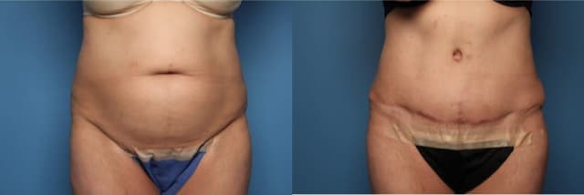 Skin Tightening procedure image