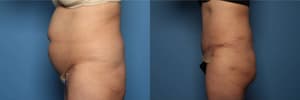 Tummy Tuck (Abdominoplasty) procedure image