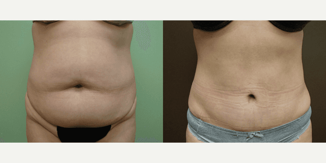 Mommy Makeover procedure image