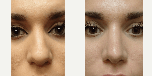 Rhinoplasty (Nose Job) procedure image