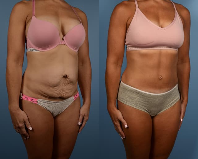 Tummy Tuck (Abdominoplasty) procedure image