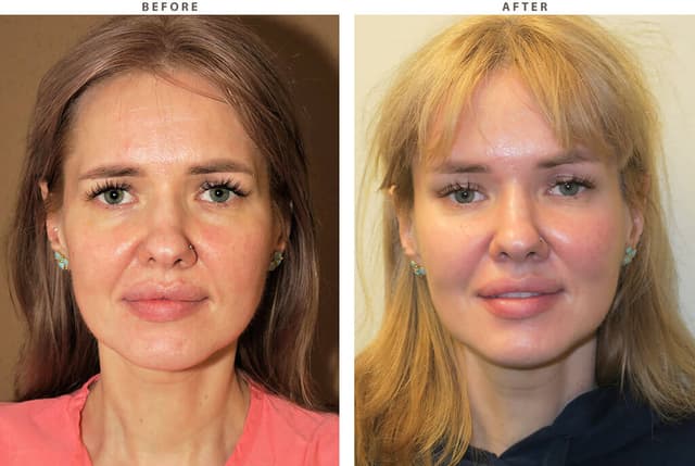 Facelift procedure image