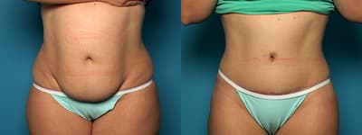 Tummy Tuck (Abdominoplasty) procedure image