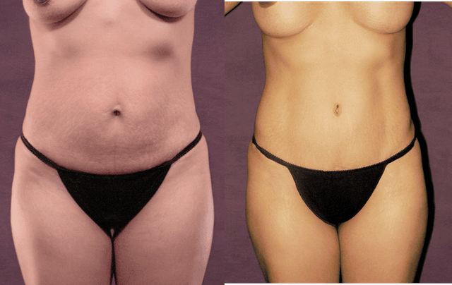 Mommy Makeover procedure image