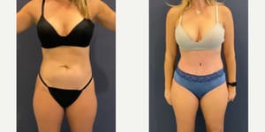 Liposuction procedure image