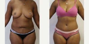 Mommy Makeover procedure image