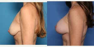 Mommy Makeover procedure image