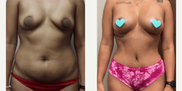 Mommy Makeover procedure image