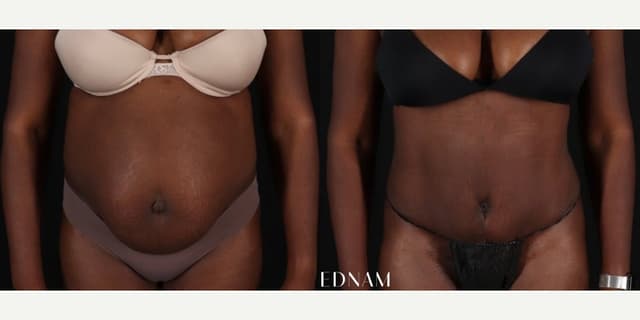 Breast Augmentation procedure image