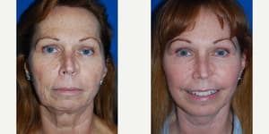 Facelift procedure image
